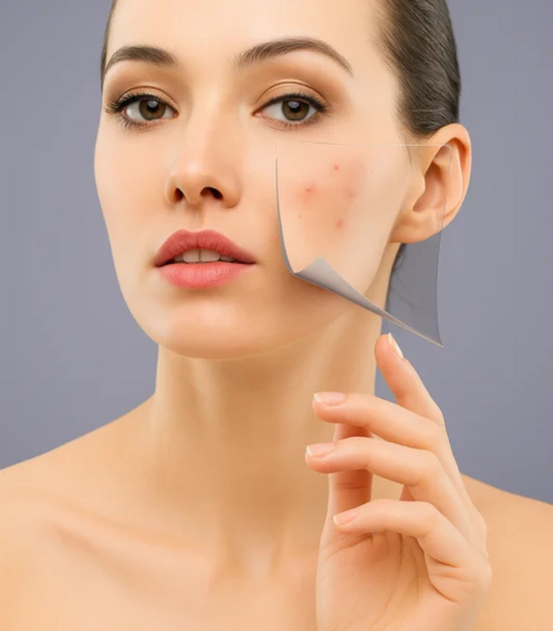 Acne and Scar Treatment