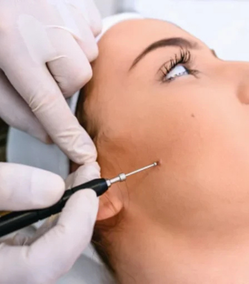 Mole Remove Treatment