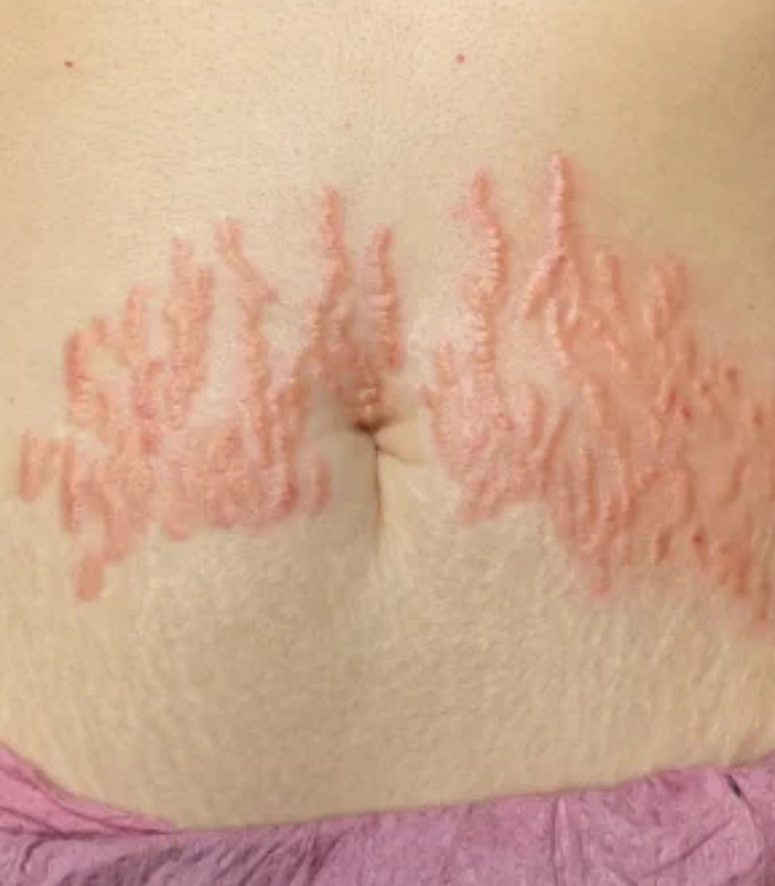Stretch Mark Treatment