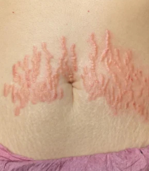 Stretch Mark Treatment