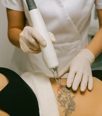 Tattoo Removal Treatment