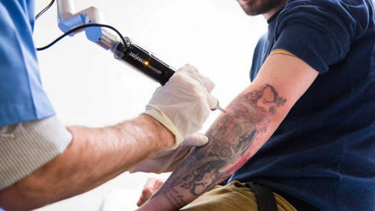 Tattoo Removal Treatment