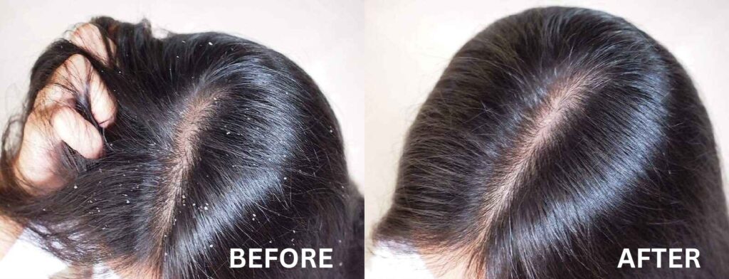 Dandruff Treatment