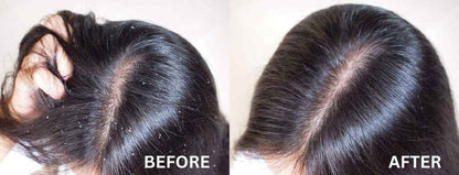 Dandruff Treatment